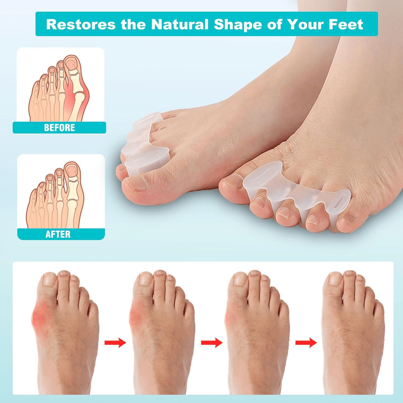 KAIDILA Toe Separators, Toe Spacers for Feet Women/Men - Bunion Corrector for Women, Toe Corrector for Toes, Bunions, Hammertoes, Hallux Valgus