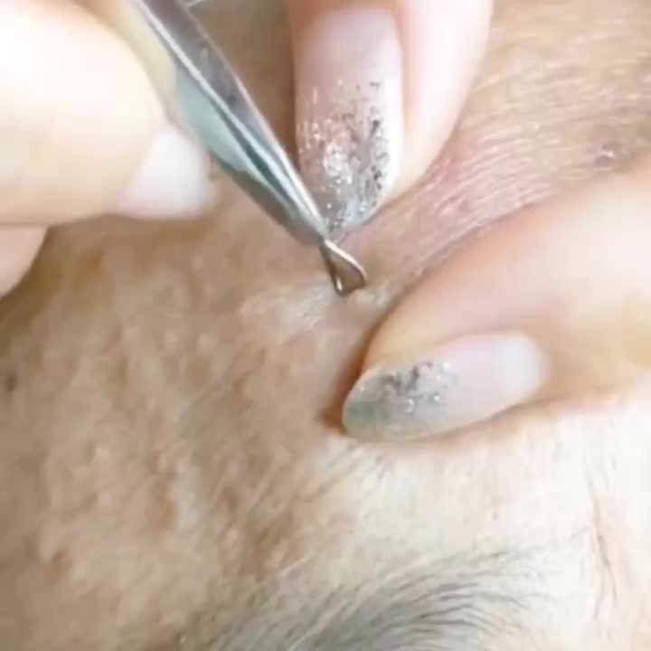 Blackhead Remover Pimple Extractor for Acne Blemish Zit Removal
