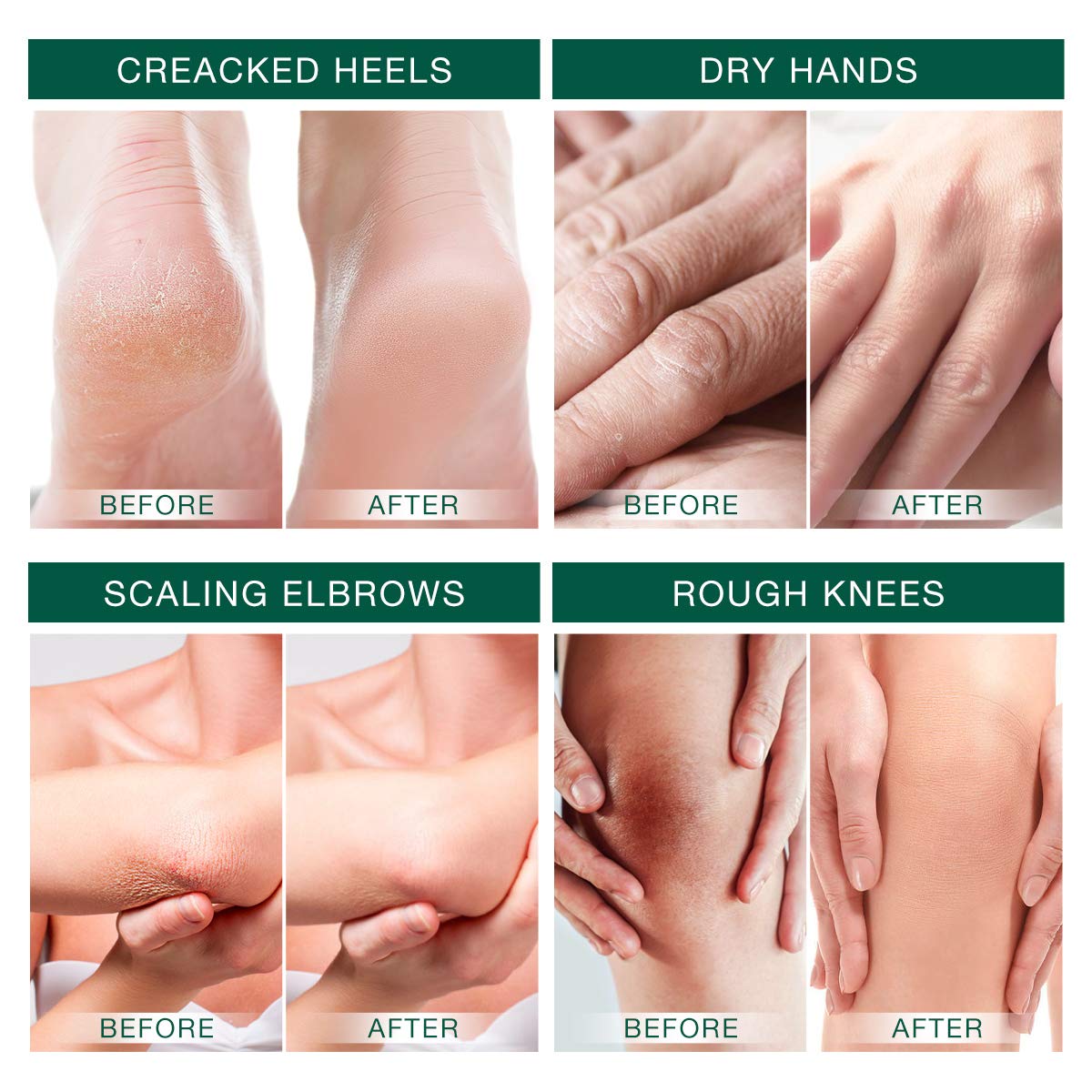 Urea 42 Foot Cream Callus Repair Cream