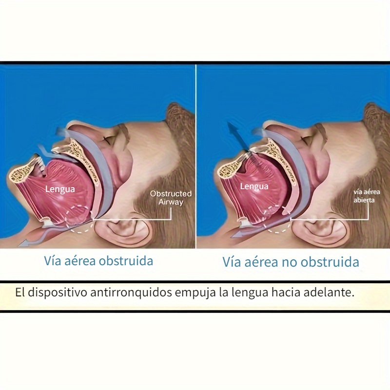 GENERICO Dispositivo Antironquidos Lingual Eficaz Noaptosensibles