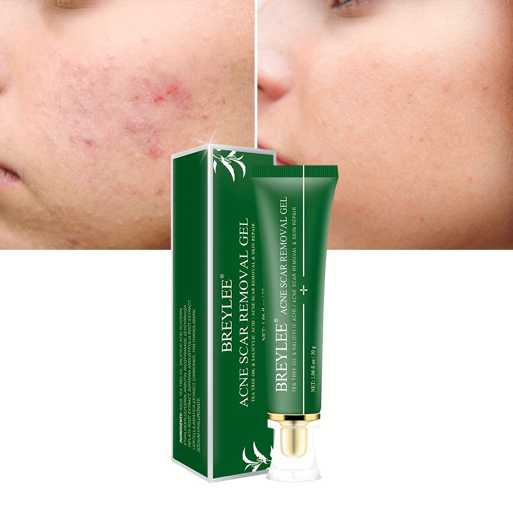 tea tree oil acne scars