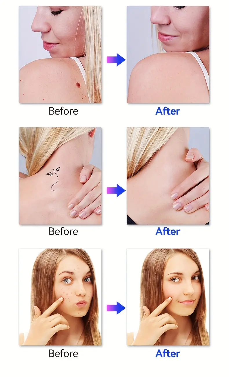 lescolton skin dark spot remover mole tattoo removal plasma pen machine facial freckles label warts removal beauty care details 7