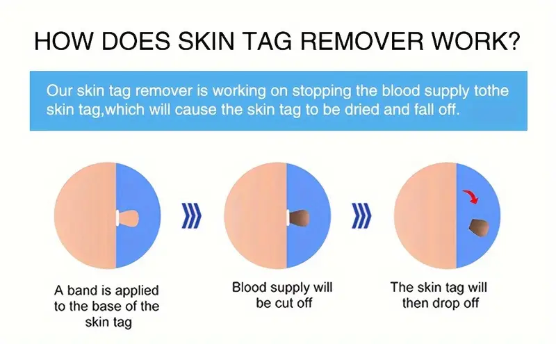 3 in 1 skin tag remover wart removal mole kit tools skin tag removal kit with fast acting and effectively easy to use at home details 1