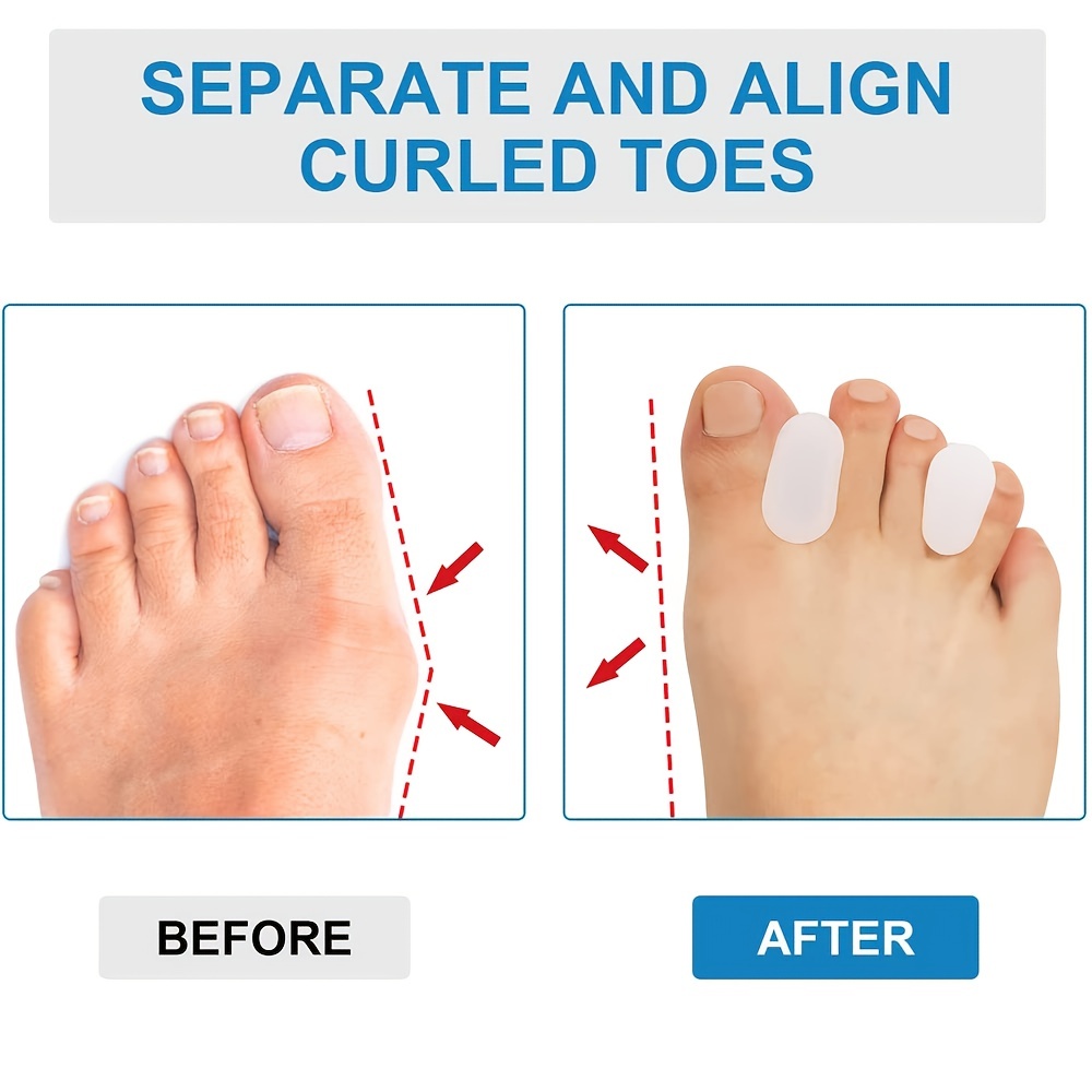 Toe Separators for Bunions - Toe Spacers, Hammer Toe Straightener, Correct  Toes and Bunion Relief : : Beauty