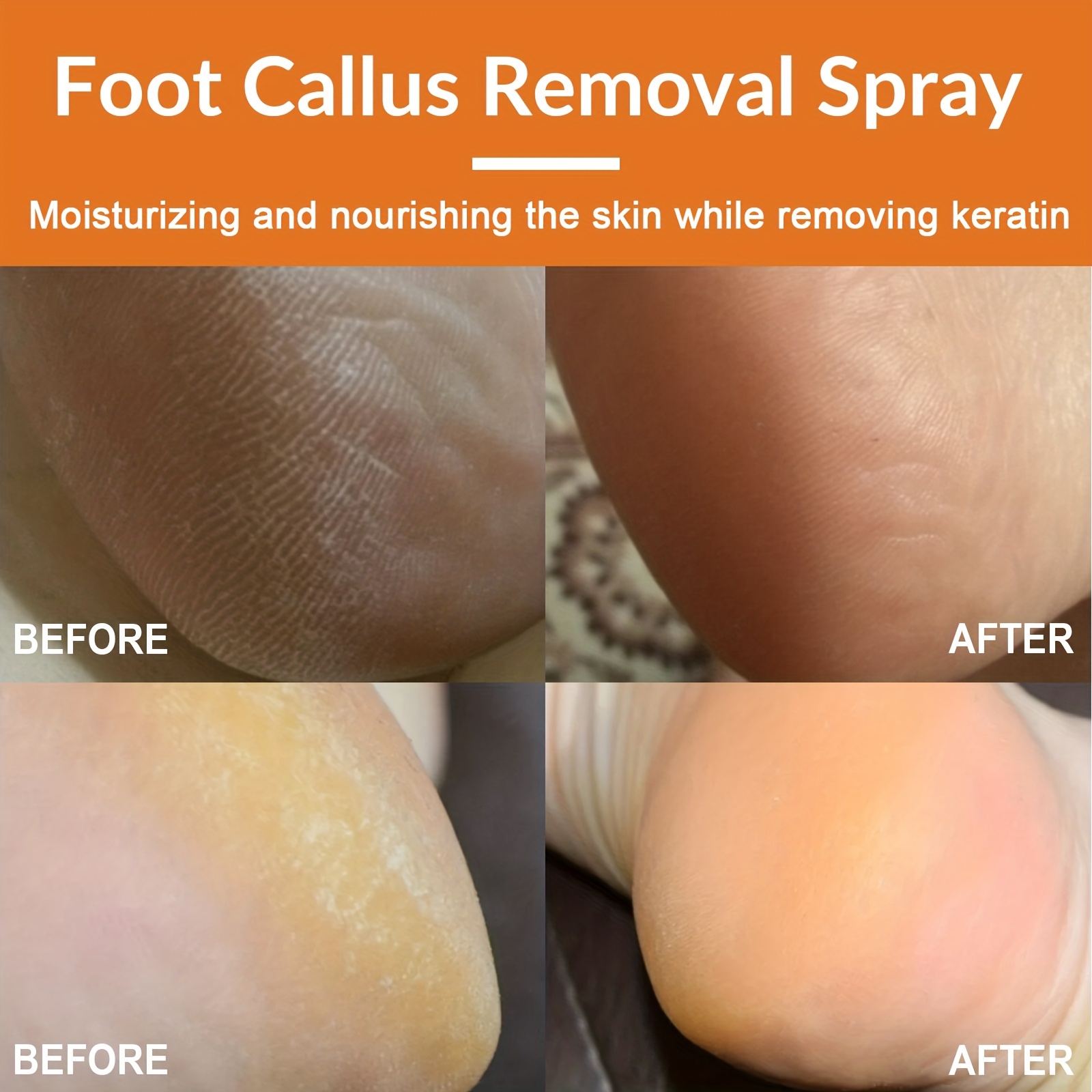 Foot Callus Removal Spray 1.01 Oz Dry Feet Skin Remover Foot Care