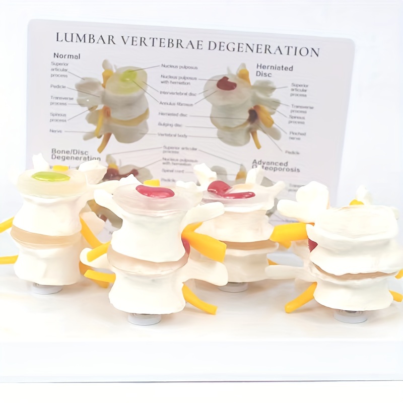 Lumbar Vertebrae Normal Lesion Combination Model Intervertebral Disc Pain Department Teaching Tool