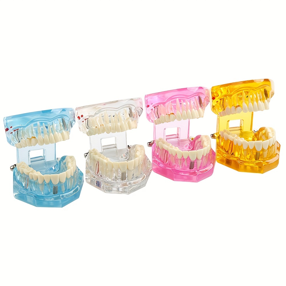 Dental Implant Model, Removable Dental Restoration Model