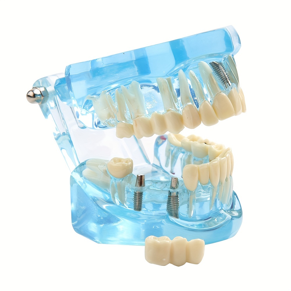 Dental Implant Model, Removable Dental Restoration Model