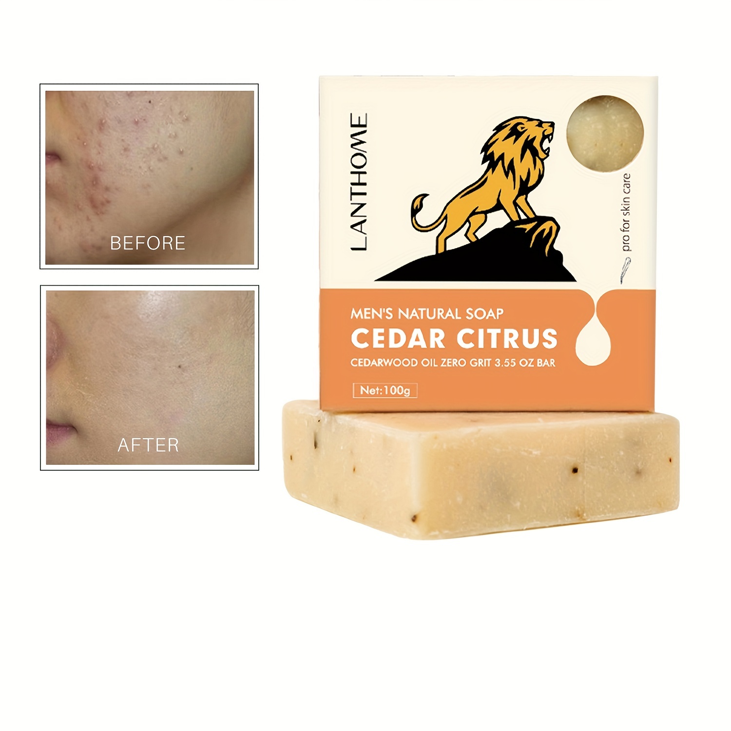 Acne Dark Spot Soap Bar for Face Body Cleansing Bath