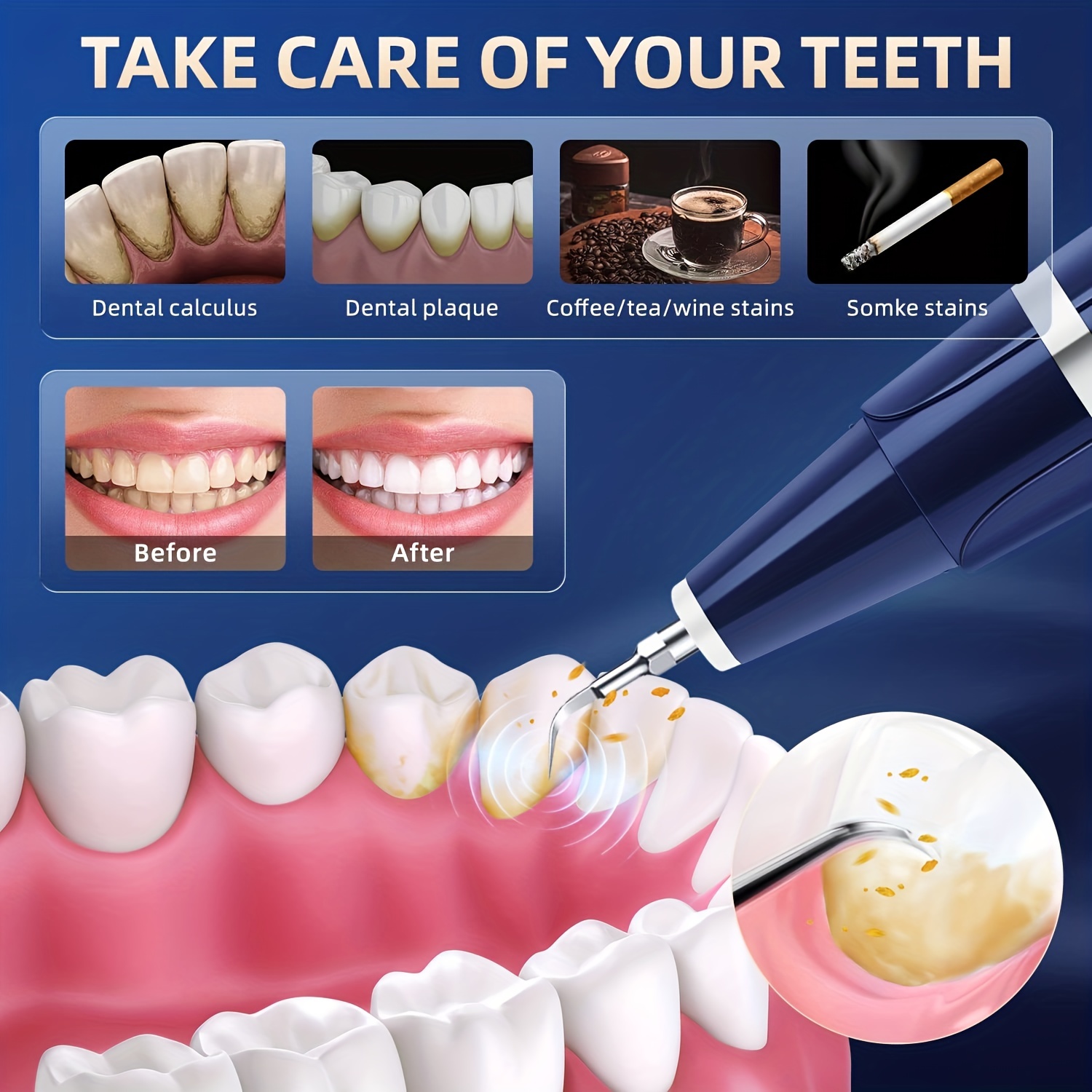 Rimozione Della Placca Per I Denti - Rimozione Del Tartaro Per I Denti, Kit  Per La Pulizia Dei Denti Per La Rimozione Del Calcolo Dentale - Temu Italy