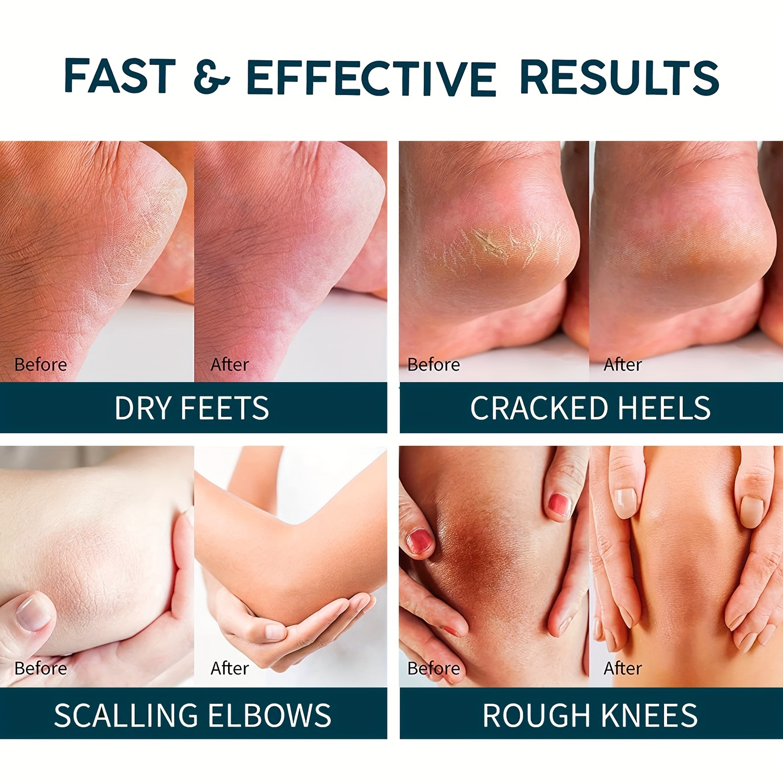Urea Cream 40 + 2 Salicylic Acid 4 9 Oz Callus Corn Remover Foot Cream