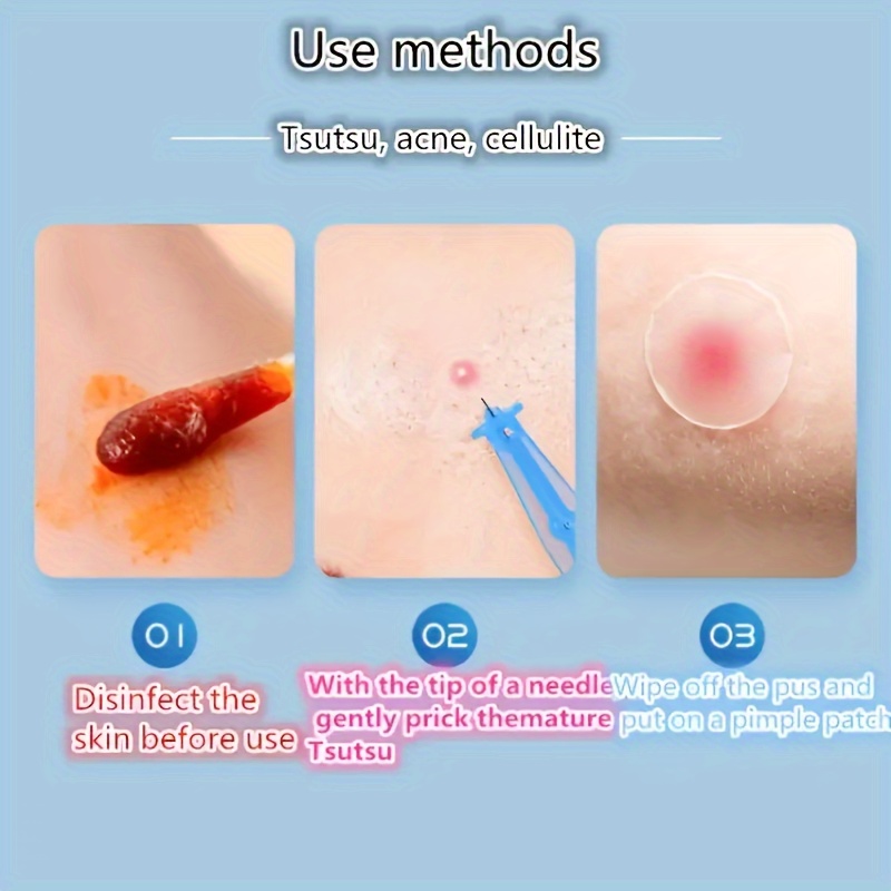 Disposable Acne Removal Needle Whitehead Blackhead Blemish - Temu Canada