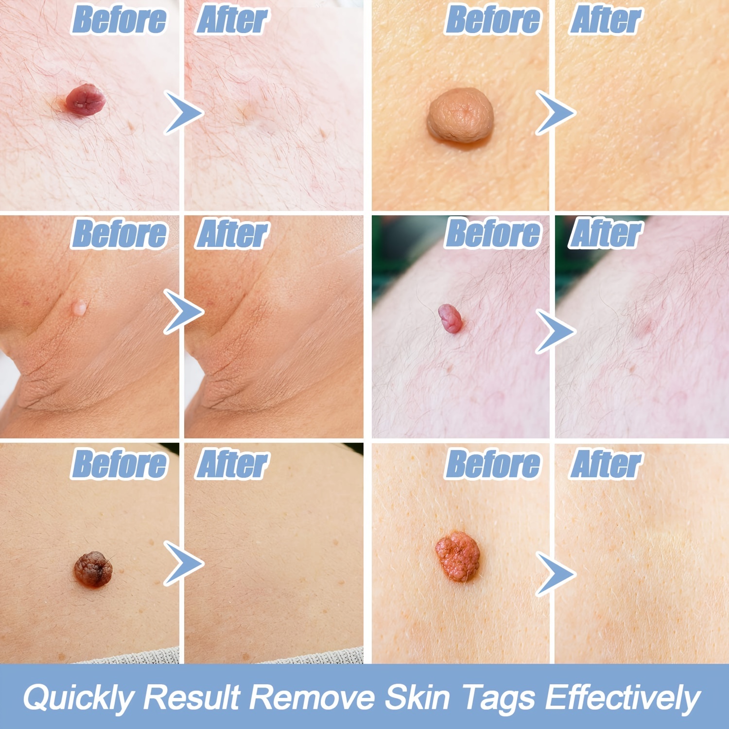 Dr.Scholl's skin tag remover : r/Keloids