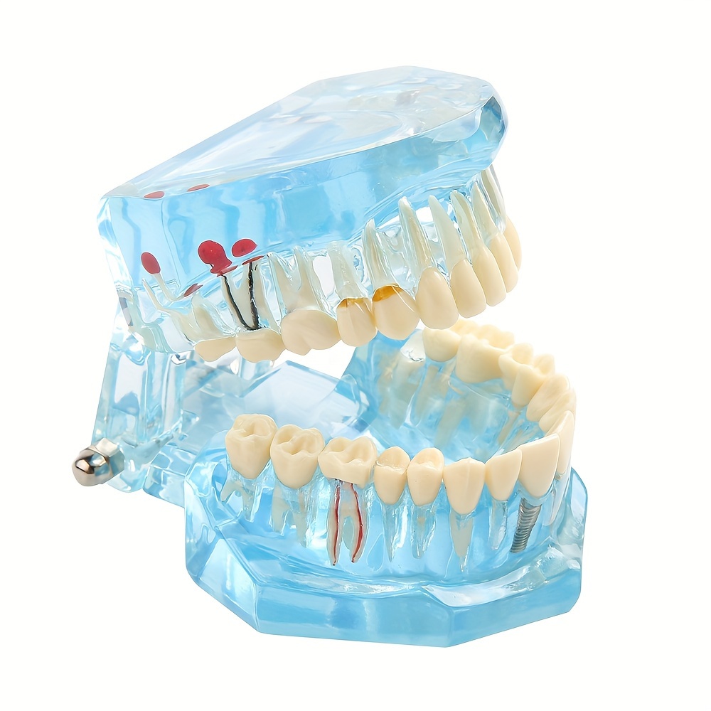 Dental Implant Model, Removable Dental Restoration Model