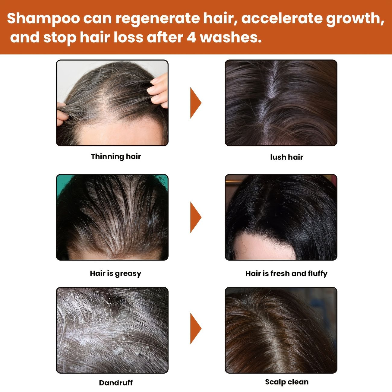 1 Bottle Of Anti Hair Loss Shampoo Nourishing And Softening Anti Hair Loss  Growth Deep Cleansing Anti Itch Foam Shampoo - Beauty & Personal Care -  Temu Canada