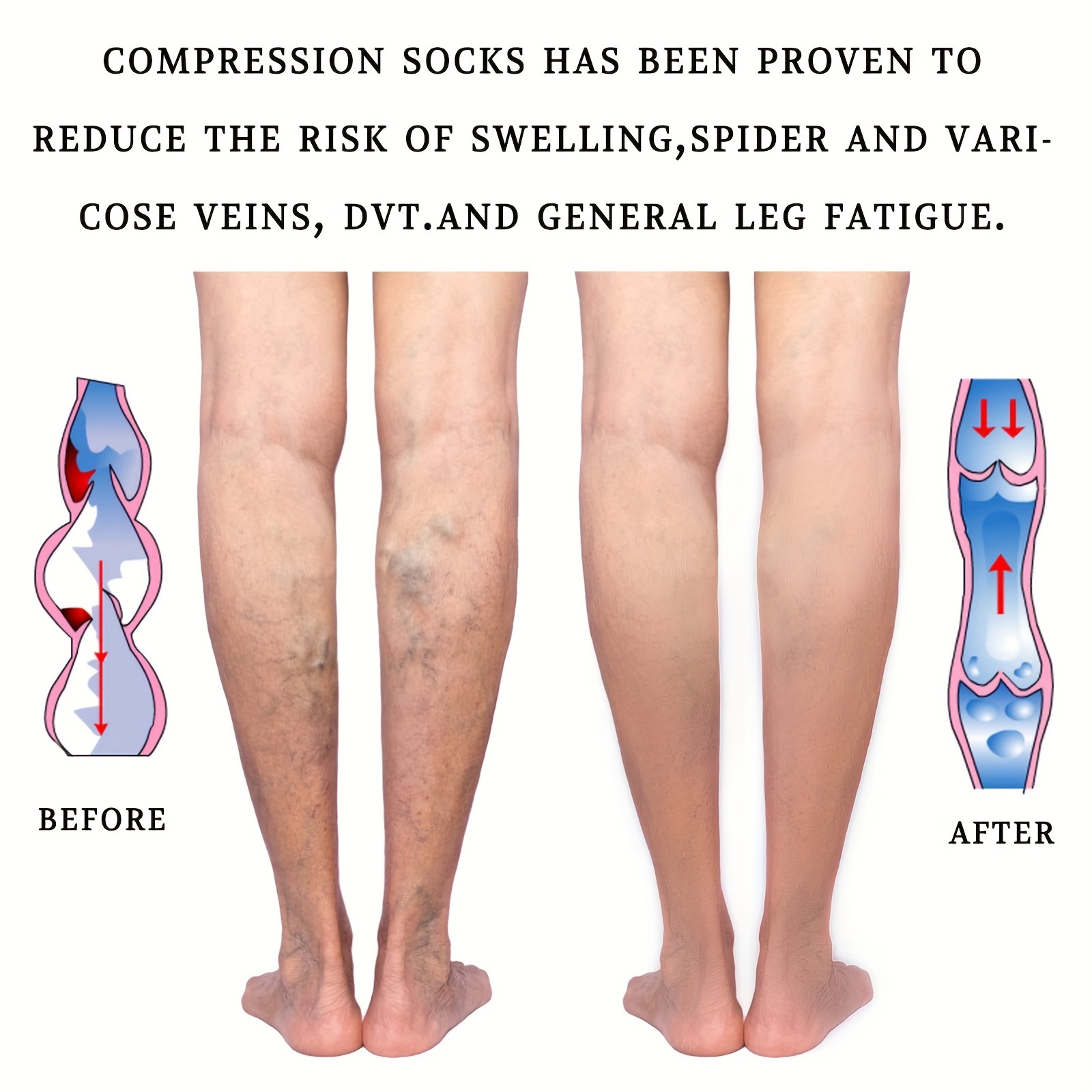 20-30 mmHg Medical Compression Stockings, Open Toe Elastic Compression  Socks for Men Women Varicose Vein Swollen Legs Travel Flight Pregnant(L)