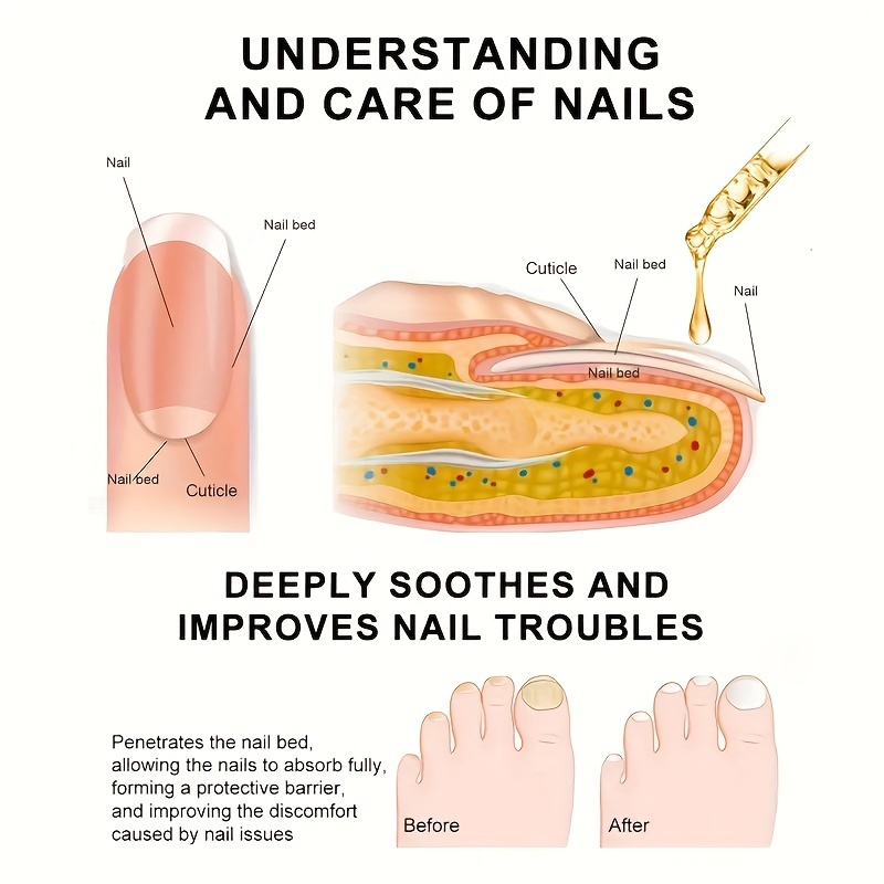 EMNote.org - Nail Bed Repair in Children with or without replacing the  fingernail. https://youtube.com/shorts/5YsmOmsj9DA?feature=share | Facebook