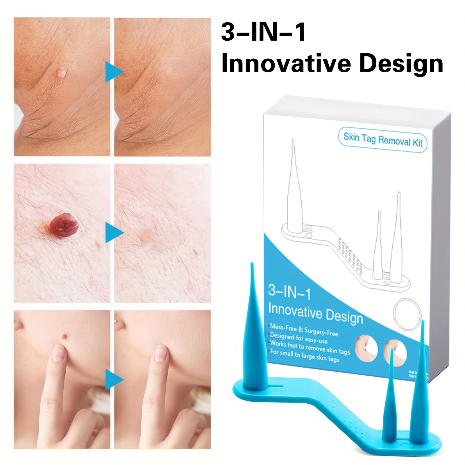 Mole Remover Pen,Skin Tag Remover Dark Spot Remover Freckle Tattoo War –  marsmaxtech