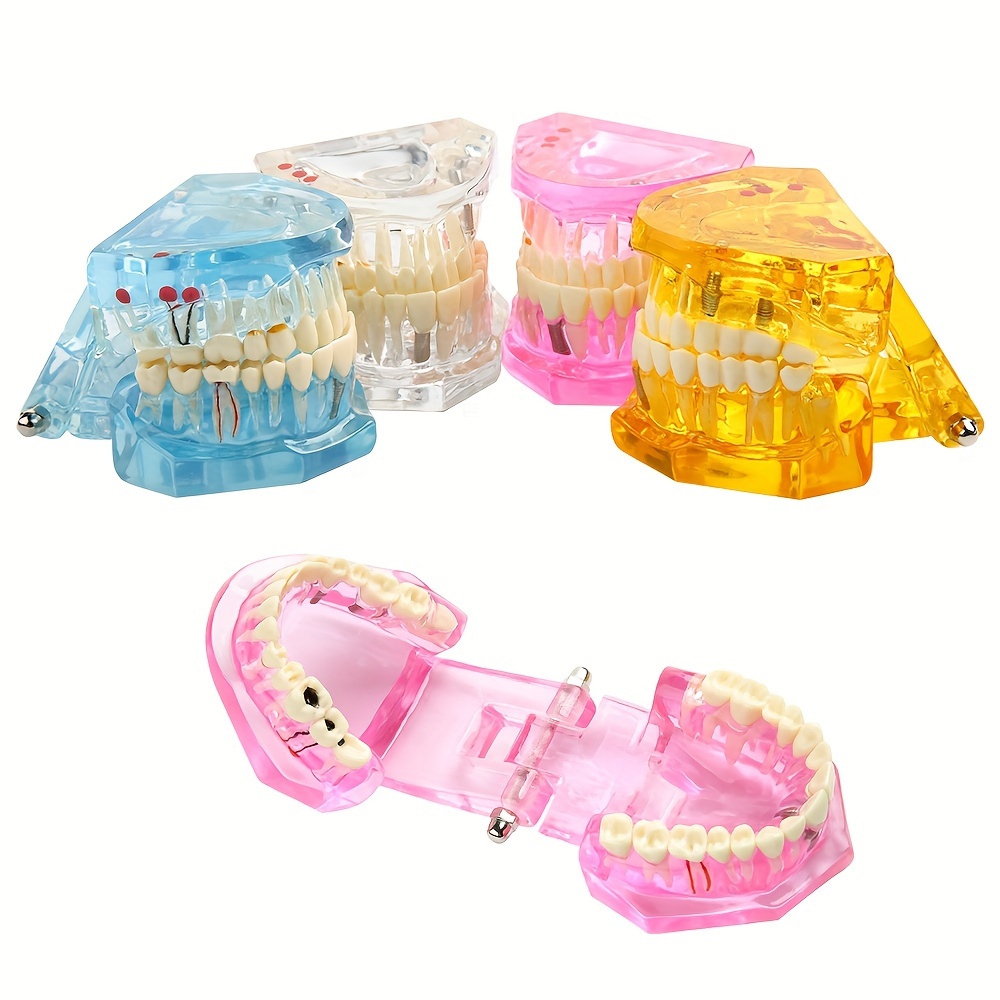 Dental Implant Model, Removable Dental Restoration Model