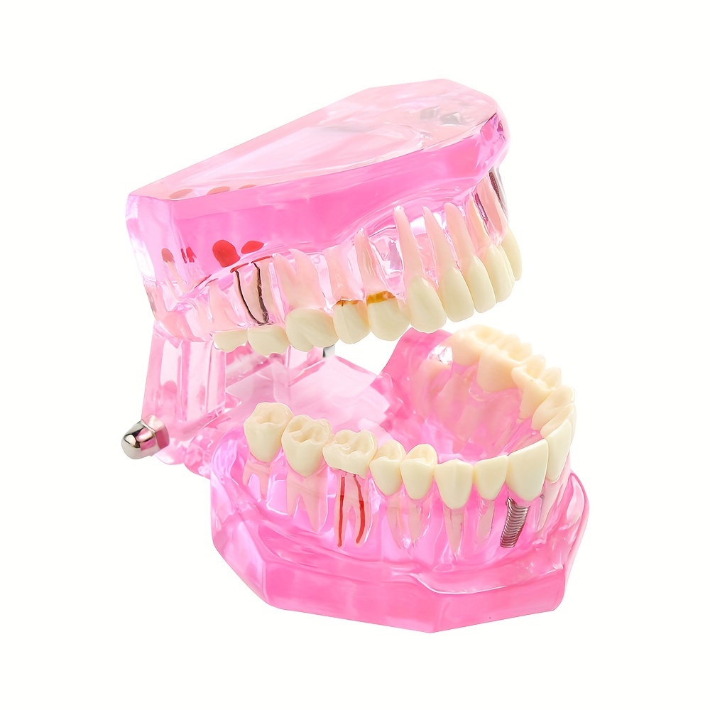 Dental Implant Model Dental Consumables Removable Dental - Temu