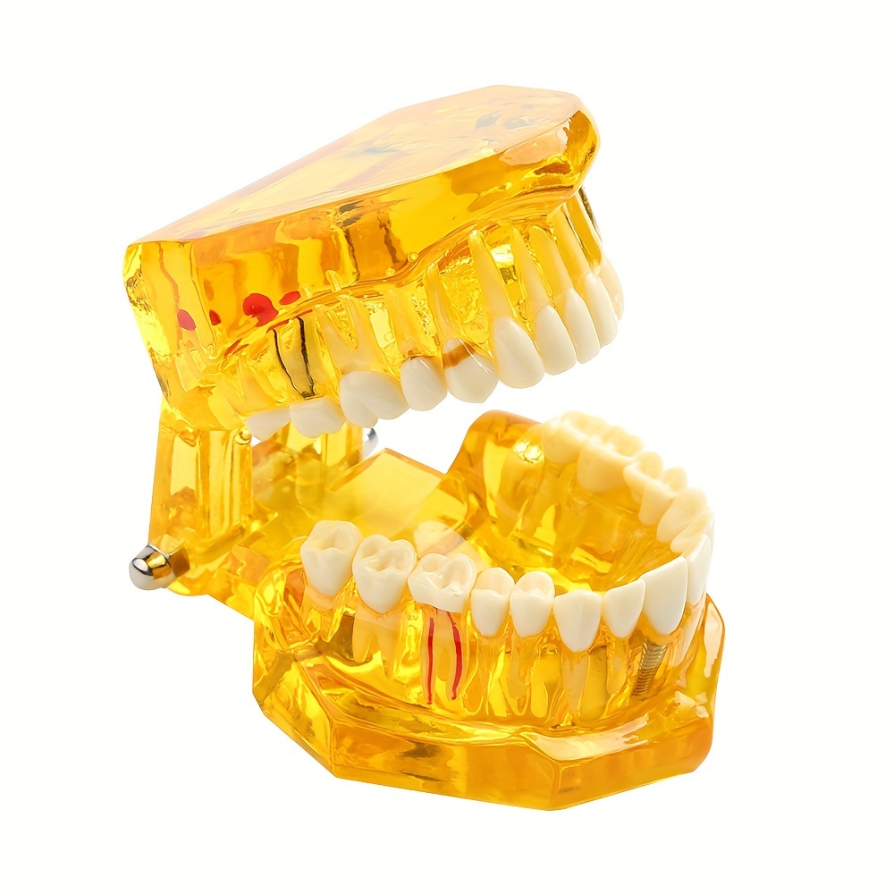 Dental Implant Model, Removable Dental Restoration Model