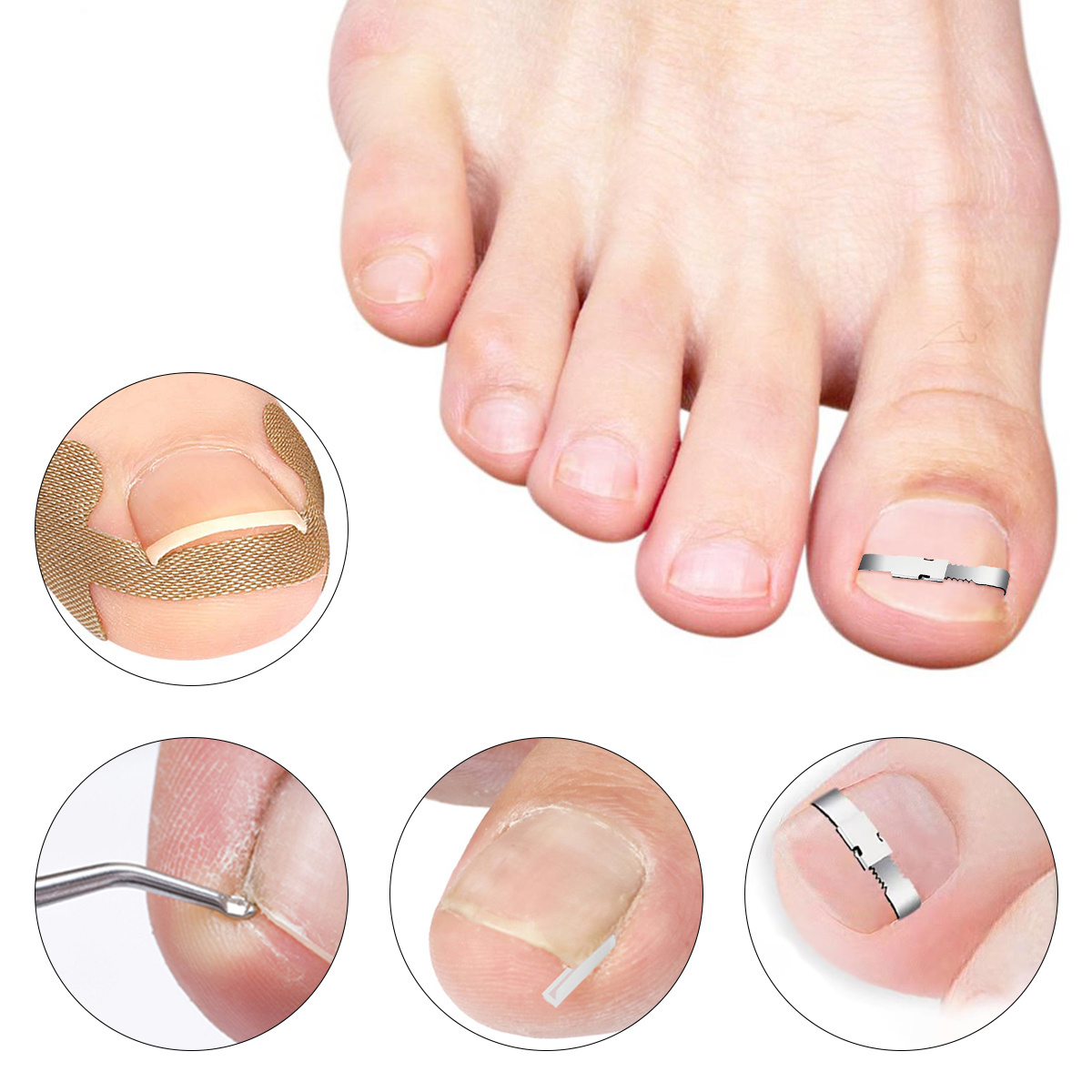 https://img.kwcdn.com/product/corrector-pedicure-tool-ingrown-toe-nail-foot-care-tools/d69d2f15w98k18-7a0abac5/open/2023-08-18/1692325578318-66cc1b5d07fb432a8cf7e2258d30fbfe-goods.jpeg