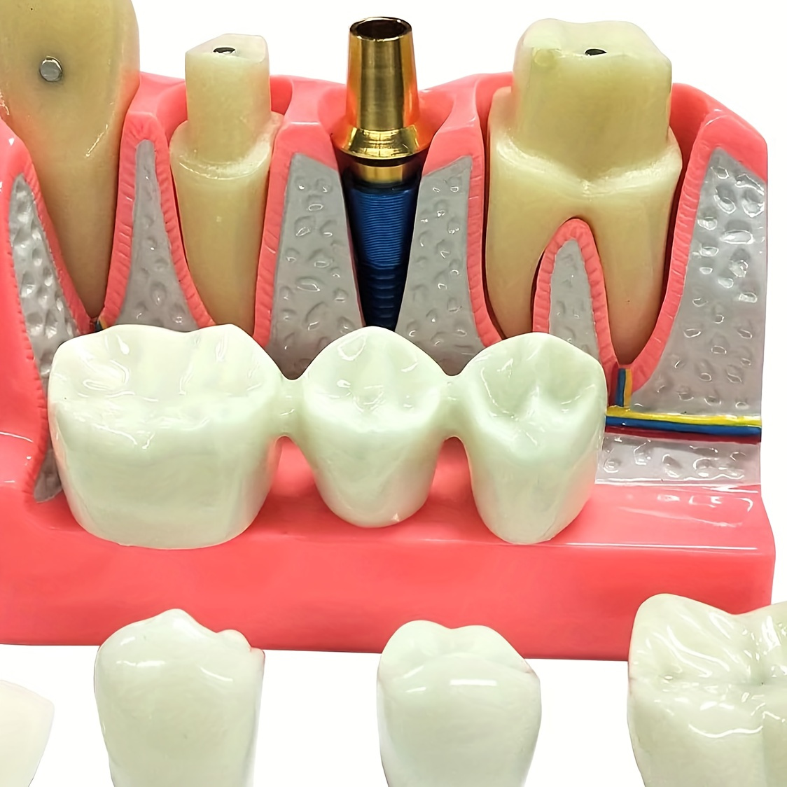 

4 Times Dental Implant Model With Removable Crown Veneers Porcelain Teeth For And Teaching Demonstration