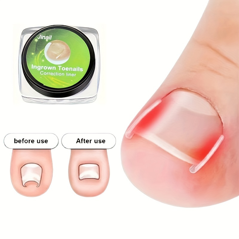 

10pcs Ingrown Toenail Correction Tool Ingrown Toe Nail Treatment Elastic Patch Sticker Straightening Clip Brace Pedicure Tool