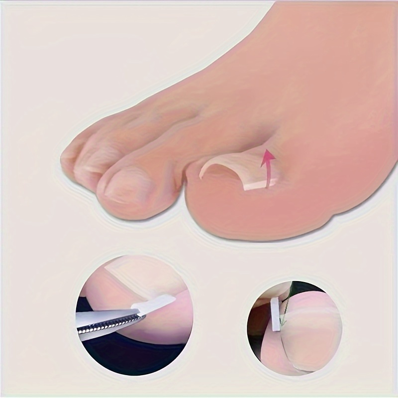 10/20/60pcs Unscented Ingrown Toenail Strips, Brace Ingrown Toenail, Pedicure Tool, Toenail Patch for Ingrown Toenail