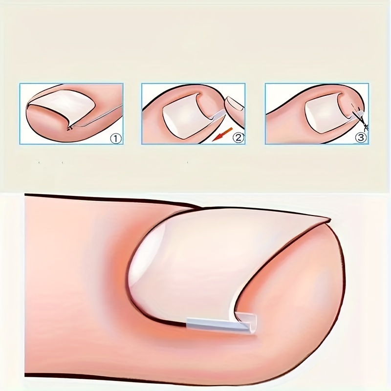 10/20/60pcs Unscented Ingrown Toenail Strips, Brace Ingrown Toenail, Pedicure Tool, Toenail Patch for Ingrown Toenail