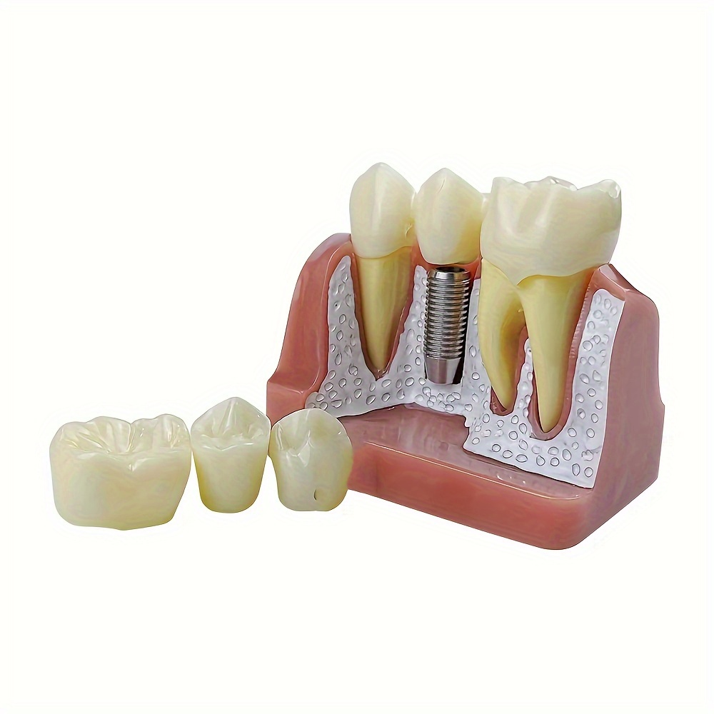 Implant Teaching Model - 4x Scale, Removable Crown & Demonstration, Pvc/resin, Ideal For Dentist Study & Training, Bright Colors, Dental Supplies