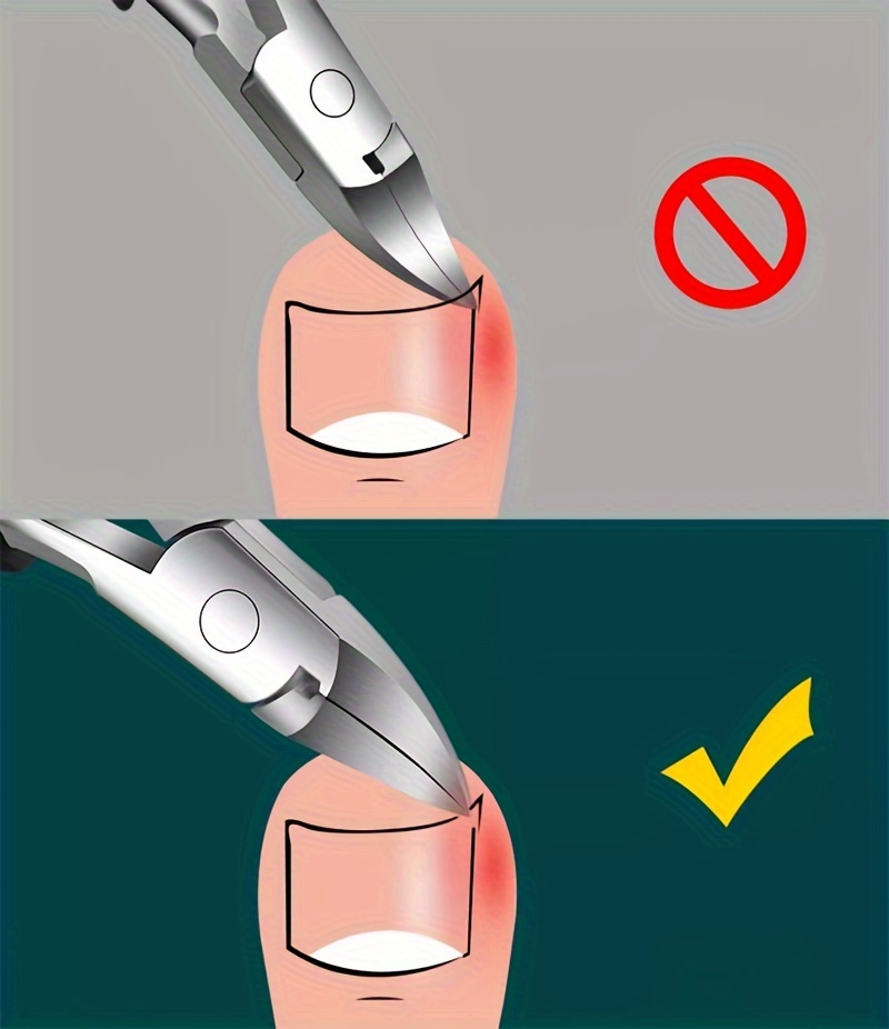 Ingrown Toenail Clipper Set, Precision Eagle Beak Pliers, Professional