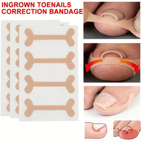 24pcs Kit for Correcting Ingrown Toenails | Eases Discomfort from Ingrown Nails, Fixes Curled Nails