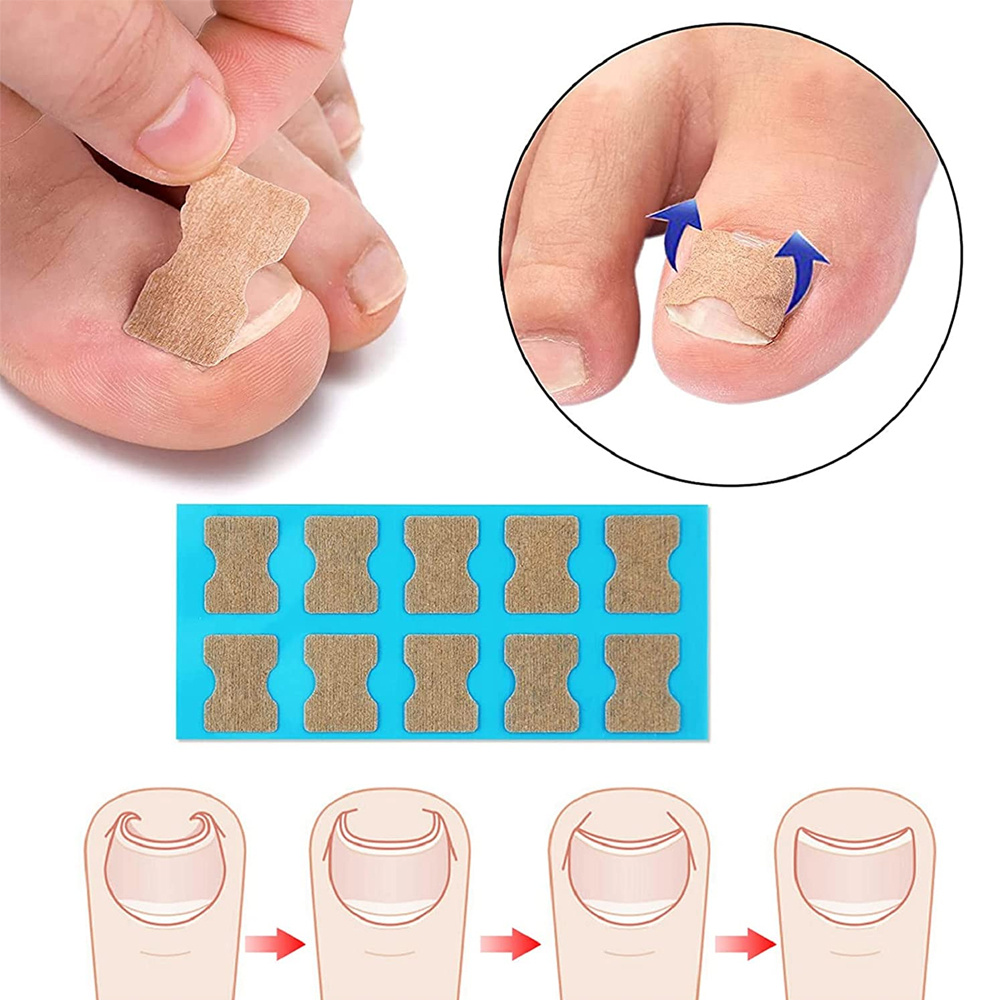 Ingrown Toenail Tools Set Ingrown Toenail Correction Patch Temu