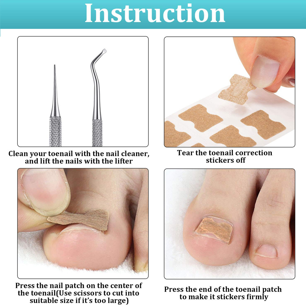 Ingrown Toenail Tools Set Ingrown Toenail Correction Patch Temu