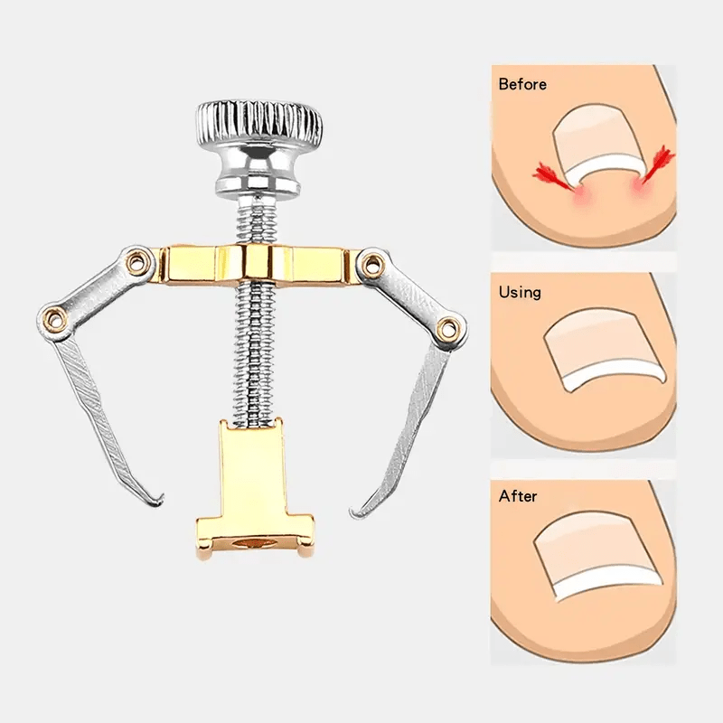 Professional Ingrown Toenail Correction Tool Set Get Back Temu