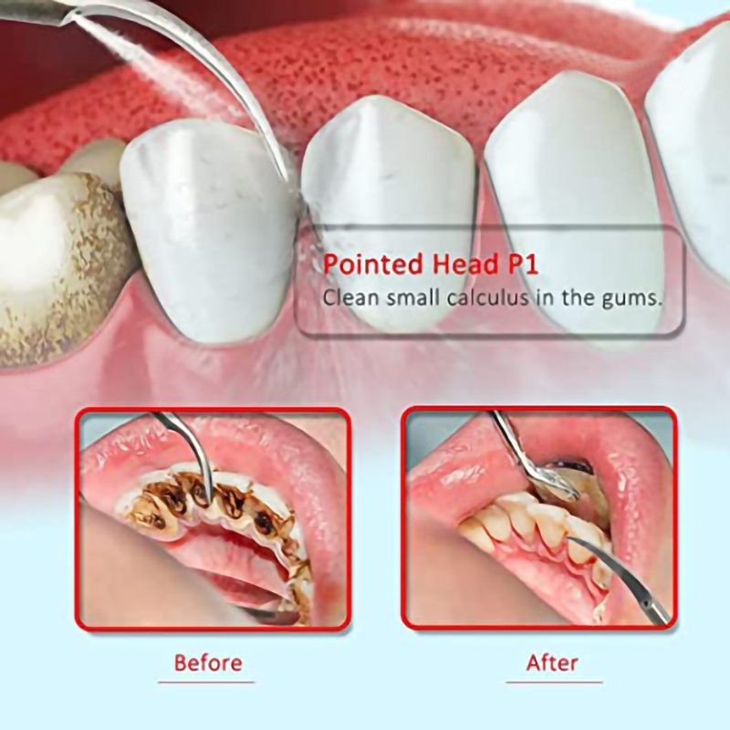 5pcs Dental Scaler Tips Cleaning Tips for Dental Equipment