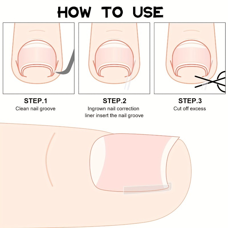 Ingrown Toenail Corrector Strips Foot Tool Nail Art Sets