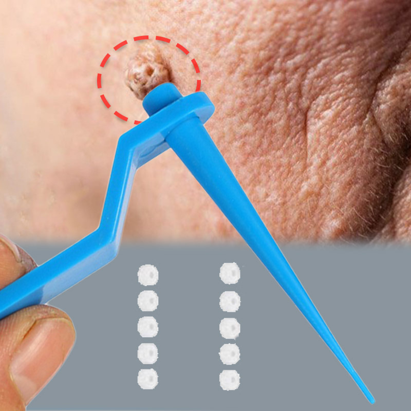 Mole removal pen skin tags remover manual : How to get rid of tattoo,  permanent makeup, warts, moles, freckles, age spots, small birthmarks, dark  spots, skin pigmentation, skin tags by Ann Dewelery