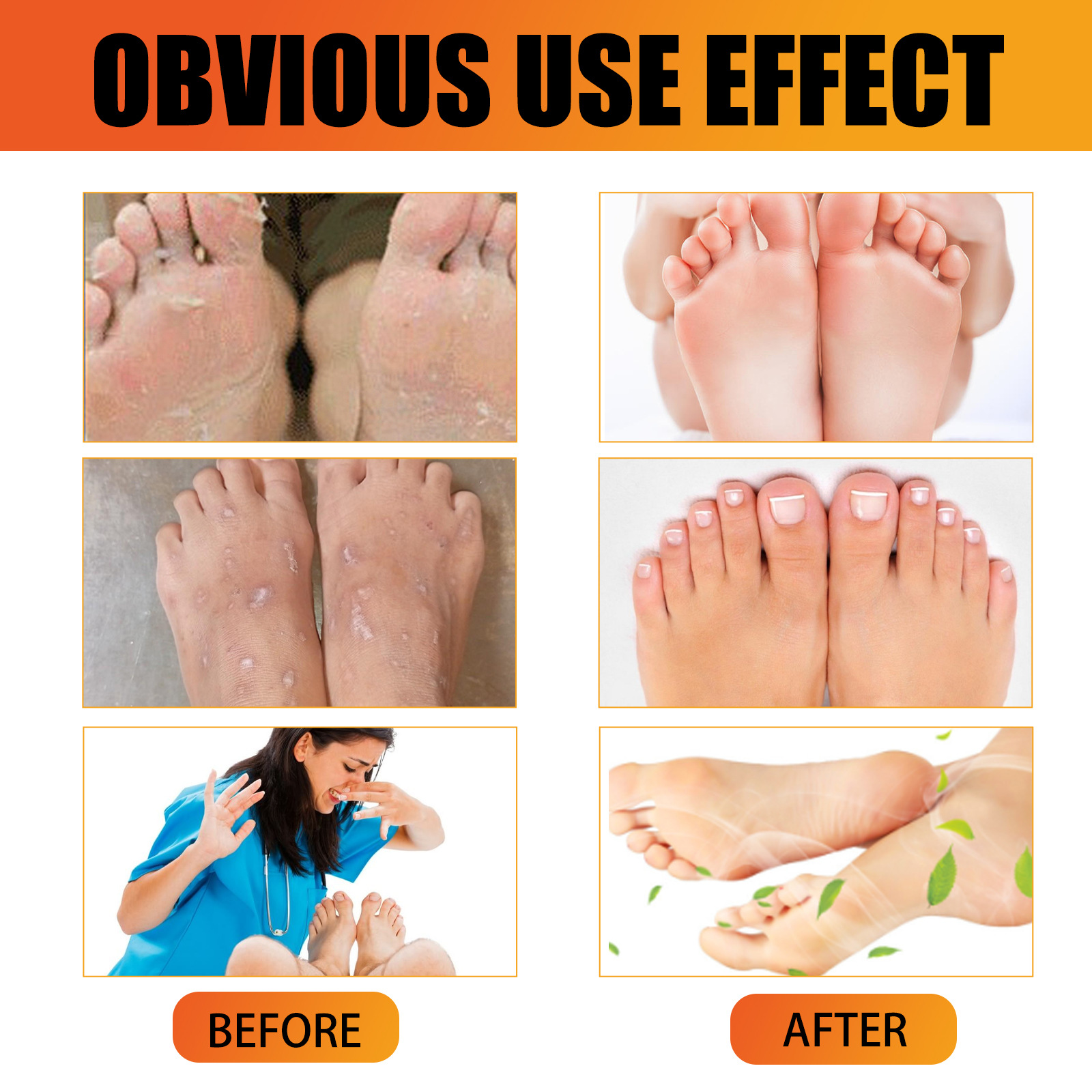 Athlete's Foot Cream for Dry Rough Cracked Skin