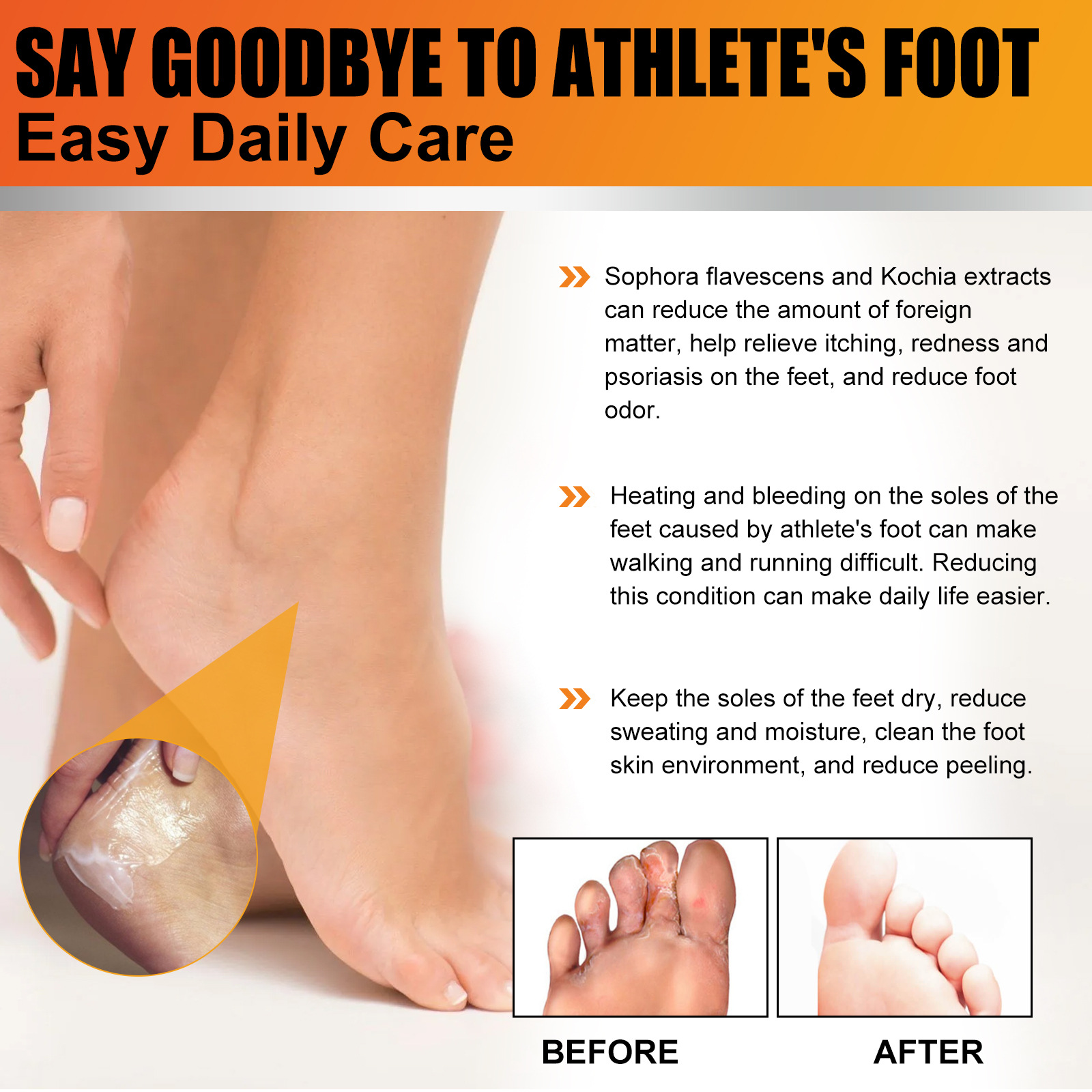 Athlete's Foot Cream for Dry Rough Cracked Skin