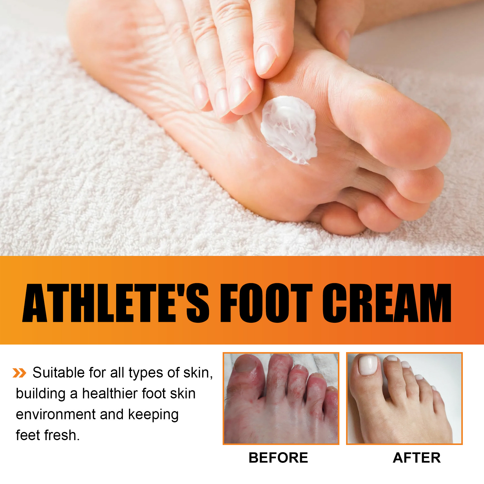 Athlete's Foot Cream for Dry Rough Cracked Skin