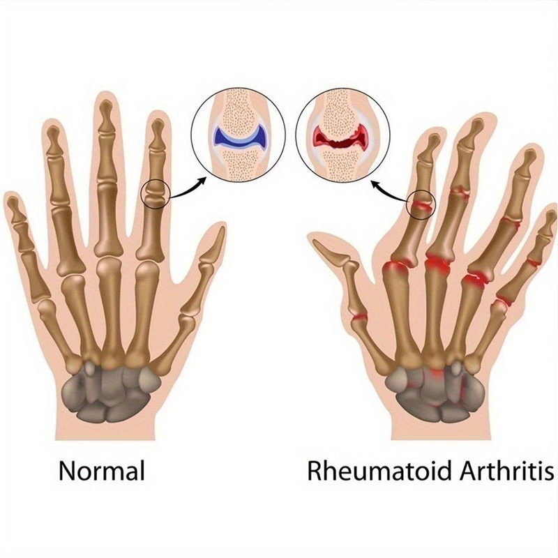 10 Gifts for Rheumatoid Arthritis