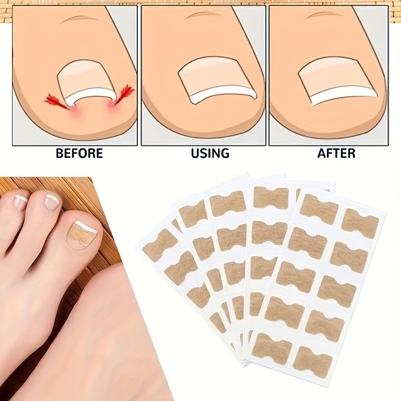 

100pcs Ingrown Toenails Corrector Nail Pads, Toenail Patches, Glue-free Nail Stickers For Ingrown Toenail Correction