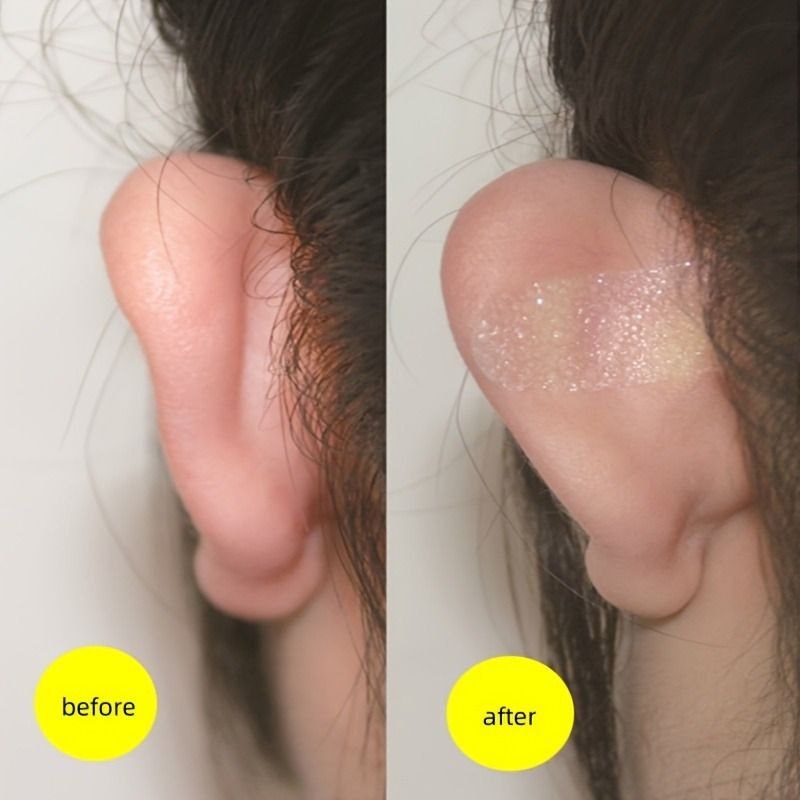 

Silicone Ear Stickers: Non-surgical Ear Correction Beauty Tool - Invisible Support Patches For Comfortable Wear