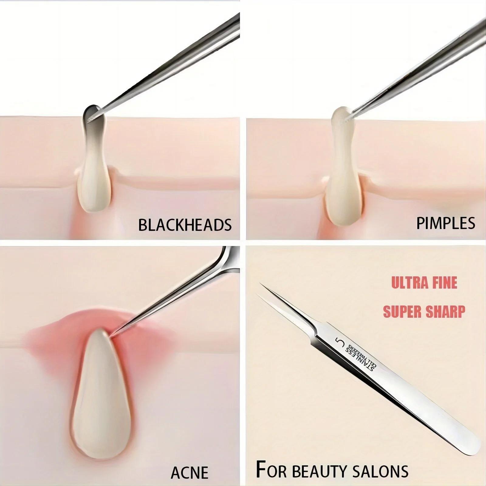 for removing blackheads and acne   steel suitable       no   details 7