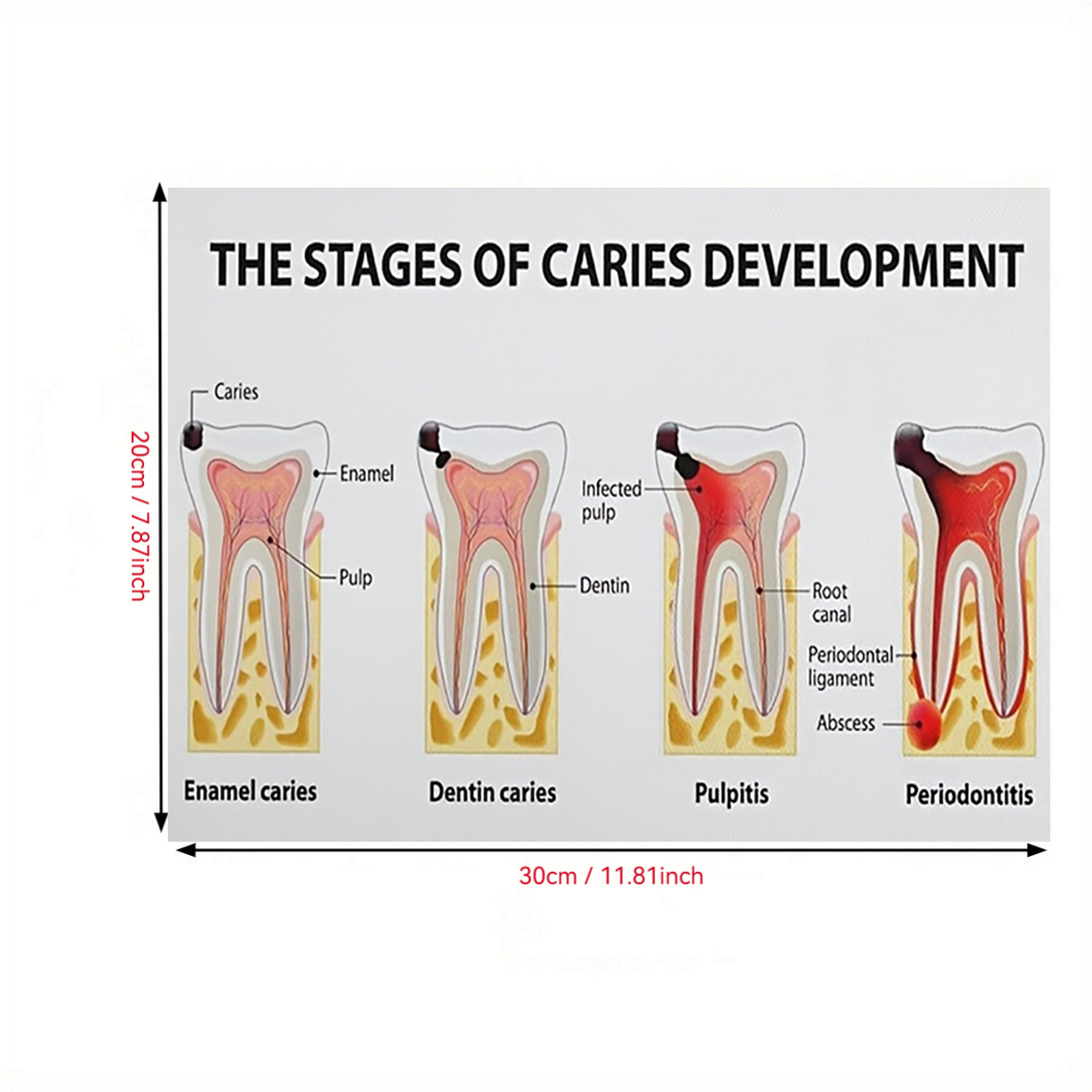 TEMU su tela piatta 2D, senza cornice, che rappresenta le fasi di putrefazione, per cliniche , ambulatori medici, aule, centri sanitari e istituzioni