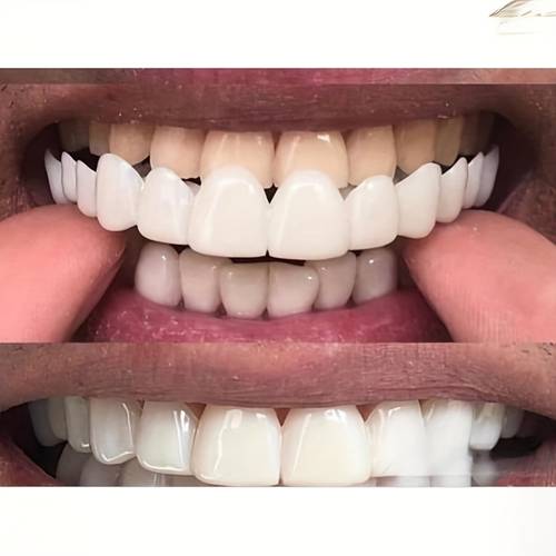 a set of two soft and comfortable white tooth guards including upper and lower parts suitable for anyone and is a of tooth guards to self