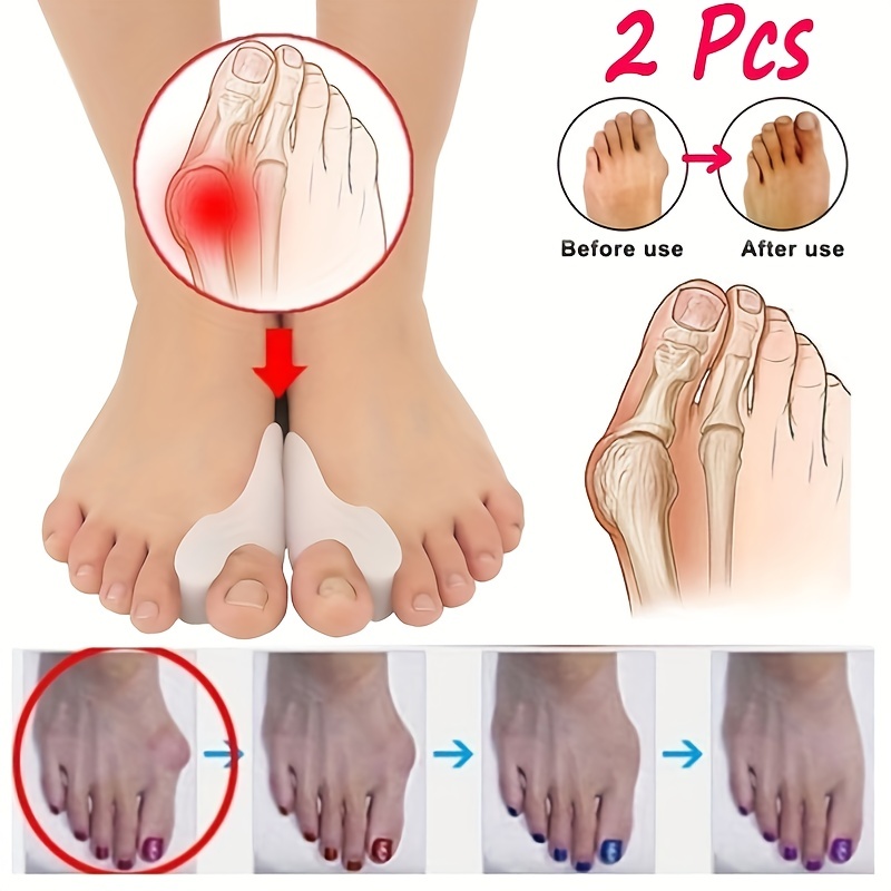 Do Bunion Correctors and Protectors Really Work?and How